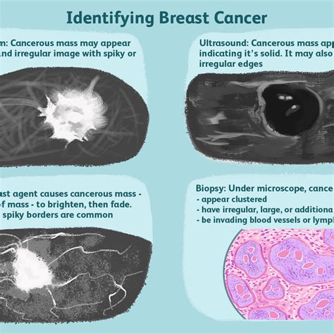 Breast Cancer Bumps Under Breast Cancer Symptom