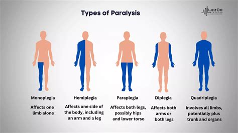 Types Of Paralysis A Detailed Look At Mobility Impairments