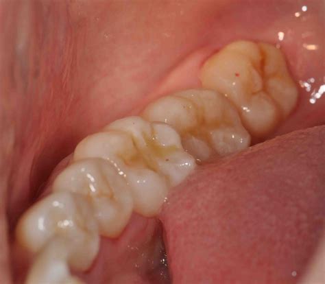 Treatment Options Dental Aesthetic With White Filling Ii On Back Teeth