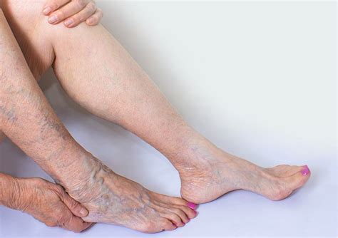 Vein Clinics Nz Varicose Vein Specialists