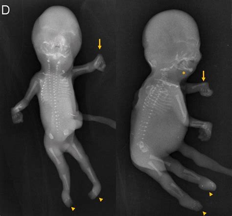 Edwards Syndrome Frontal And Lateral Foetal Radiography Aplasia Radii