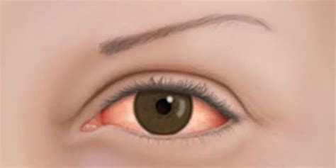 Eye Allergy Diagnosis And Treatment American Academy Of Ophthalmology