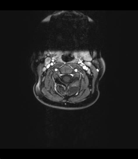 Aneurysmal Bone Cyst Cervical Spine Image