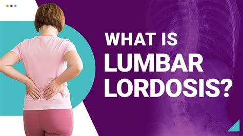 Loss Of Lumbar Lordosis Exercises