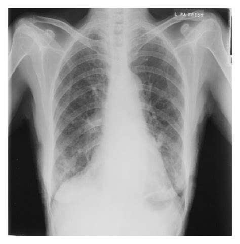 Etiologies of low lung volumes and hyperinflation are also discussed. Digital chest X-rays of (a) normal lung, (b) LC in left ...