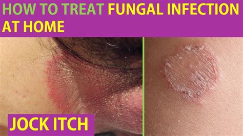 Is It Ringworm Signs And Symptoms Tinea And Jock Itch How To Treat Skin Fungal Infection