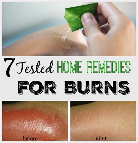 Home Remedies For Burns Home Remedies For Burns Burn Remedy Remedies