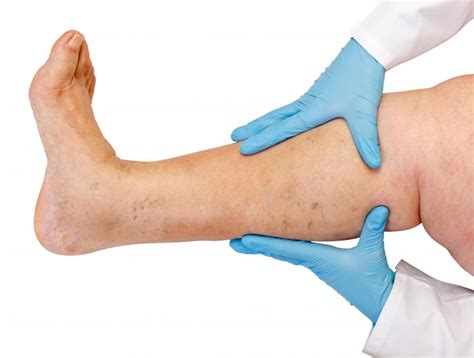 What Causes Leg Inflammation With Pictures