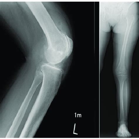 Post Operative Lateral And Skyline Radiographs Of Knee At 1 Year