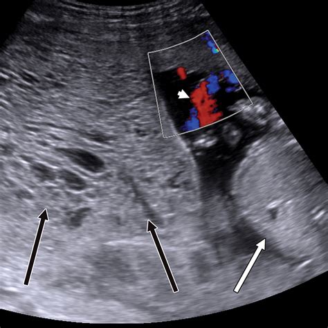 Gestational Trophoblastic Disease Clinical And Imaging Features