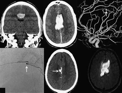 Coronal A And Transverse B Ct Scan With Hematoma In The Corpus