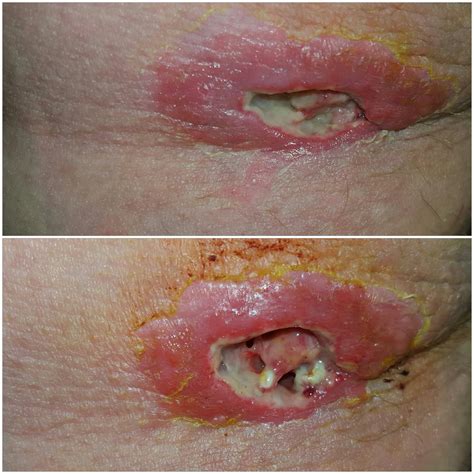 Mrsa Treating It Naturally My Journey With Mrsa Cellulitis