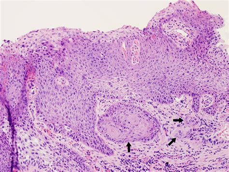 Invasive Squamous Cell Carcinoma Causing Laryngeal Leukoplakia Iowa