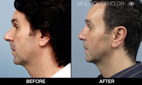 Male Rhinoplasty Before And After Photo Gallery Tps