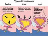 Mixed Incontinence Treatment