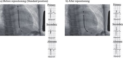 Comparison Of Fluoroscopic Images Before And After Lead Repositioning