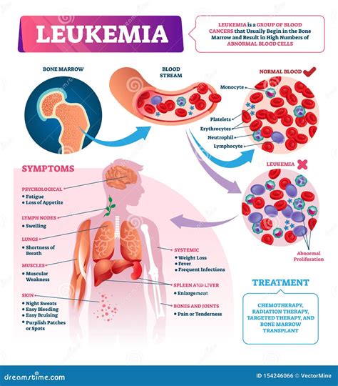 Leukemia Vector Illustration Labeled Educational Blood Cancer