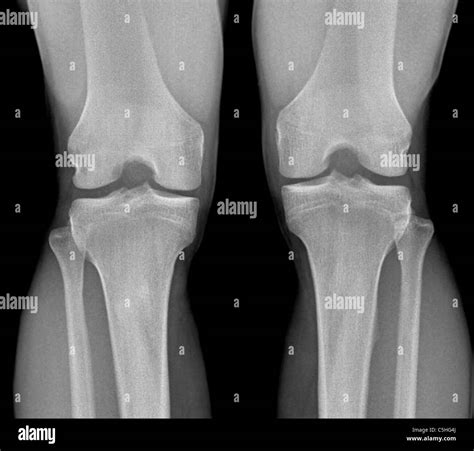Normal Knee X Ray Hi Res Stock Photography And Images Alamy