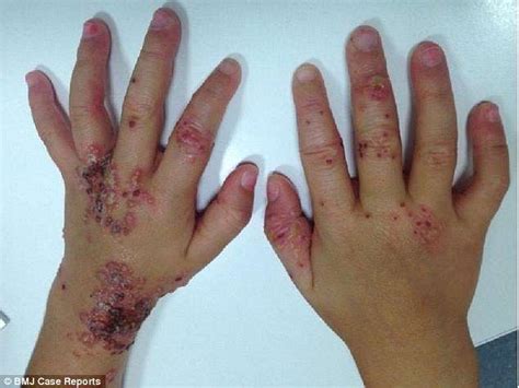Toddler Left Covered In A Rash After Catching Herpes From Her Father