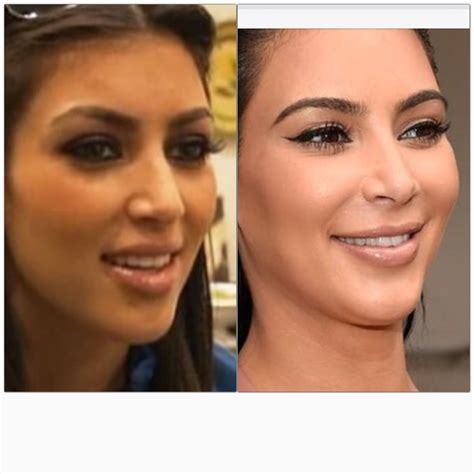 Kim Kardashian Nose Job Nose Job Rhinoplasty Nose Jobs Celebrity