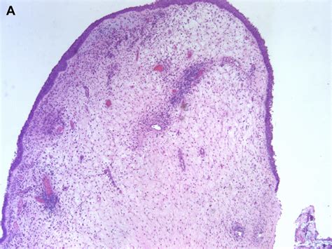 Inflammatory And Infectious Lesions Of The Sinonasal Tract Surgical