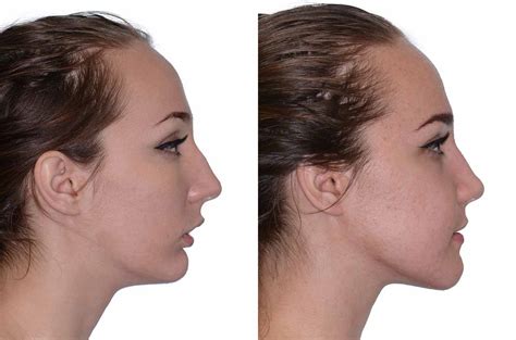 Bite And Chin Asymmetry Correction Corrective Jaw Surgery Dr Antipov