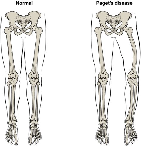 One is the ulna, and the other. This illustration shows the normal skeletal structure of ...