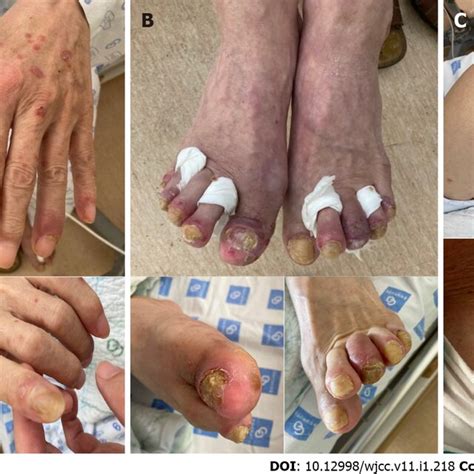 Psoriatic Nail Dystrophy And Polyarthritis Showing Erythematous