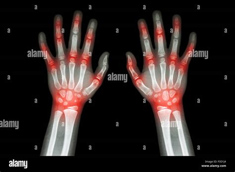 Rheumatoid Arthritis Gout Arthritis Film X Ray Both Hands Of Stock