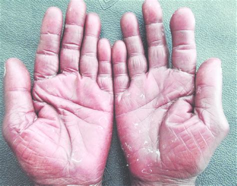 Erythema And Desquamation Seen Over Both Palms Download Scientific