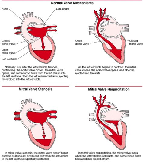 Understanding Mitral Valve Chordae Repair Heart Surgery Information