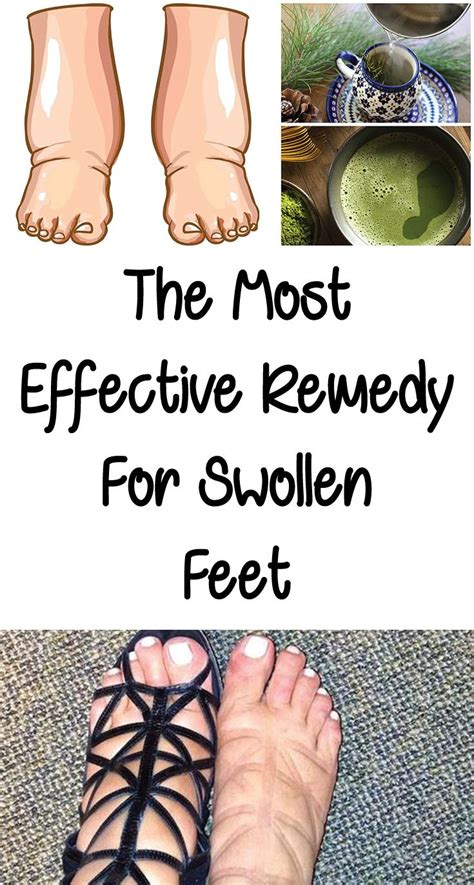The Most Effective Remedy For Swollen Feet Swollen Feet Remedy Foot