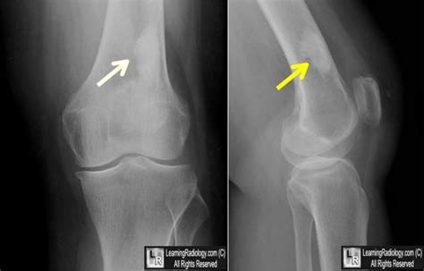 Giant Bone Island Frontal And Lateral Knee Radiographs Show A Large