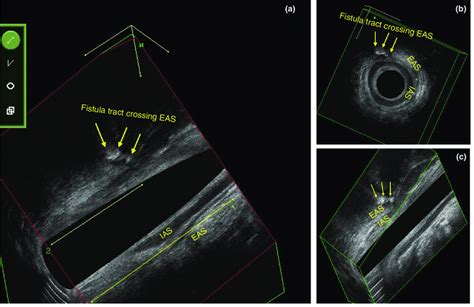 Three Dimensional Endoanal Ultrasound Showing A High Trans Sphincteric Download Scientific