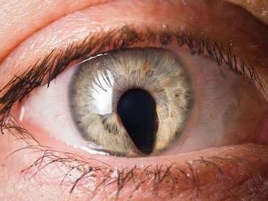 Our world is filled with computer screens, tablets, and cell phones that take their toll on our eyes. Iridocorneal Endothelial Syndrome Symptoms | Vision Pro ...