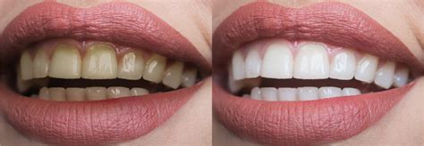 Cosmetic Dentistry Before And Afters Change Your Smile To Look Better
