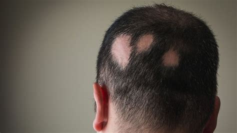 Alopecia Areata And Hair Loss Causes Symptoms Treatment The Amino
