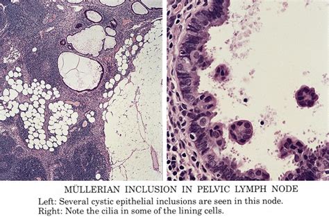 Pathology Outlines Müllerian Inclusions Cysts