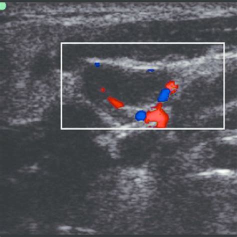 Color Doppler Ultrasound Image Of Benign Lymph Node Showing