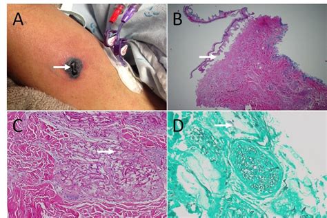 A Solitary Necrotic Lesion In A Man With Acute Myeloid Leukemia And
