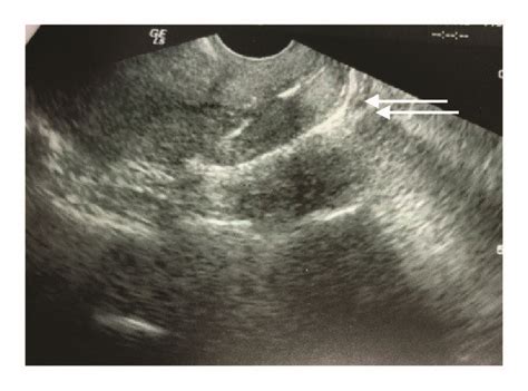 Ultrasound Showing A Hyperechoic Cervix Download Scientific Diagram