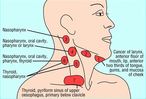 Early Stage Cancer Lymph Nodes In Neck Allthingspoliz