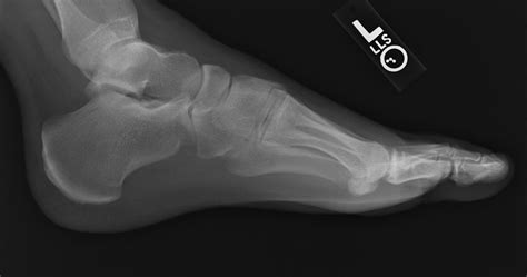 Chip Bone Fracture Treatment Surgery Chip Bone Recovery