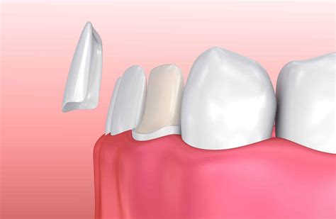 Invisalign Vs Veneers 21 Pros And Cons Which Is Best