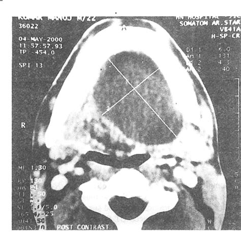 Figure 2 From Giant Epidermoid Cyst Of The Floor Of Mouth Semantic