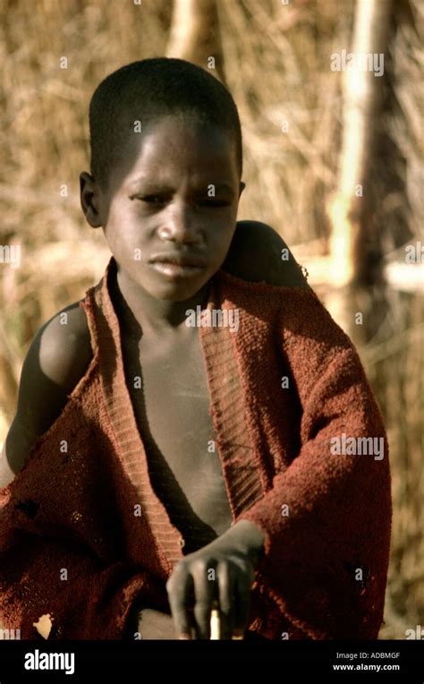Kwashiorkor Child