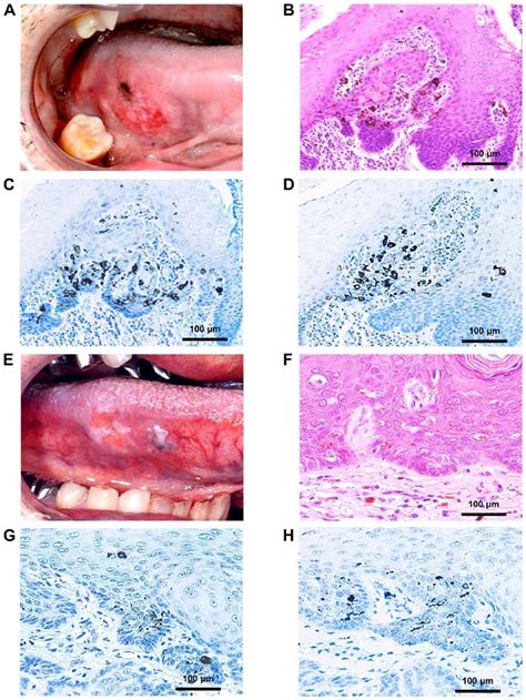 Macroscopic And Microscopic Results Of Pigmentation In Pigmented Oral