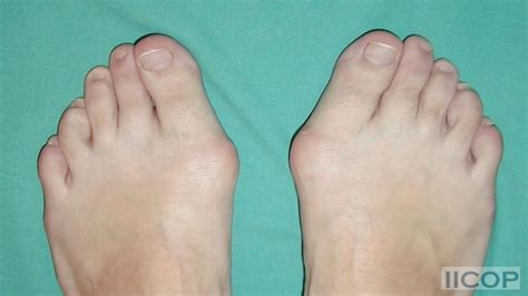 Técnicas Diferentes Para La Corrección Del Hallux Valgus Los Mejores