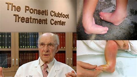 The medical term for clubfoot is talipes equinovarus. A Walking Miracle - The Ponseti Method for Clubfoot ...