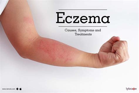 6 Types Of Eczema Symptoms And Causes